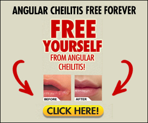 Angular Cheilitis