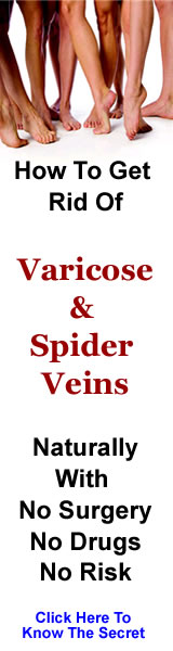 Get Rid Varicose Veins