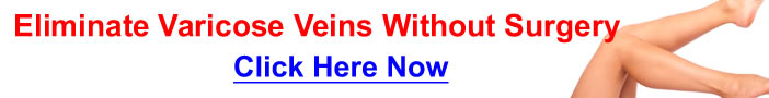 Get Rid Varicose Veins